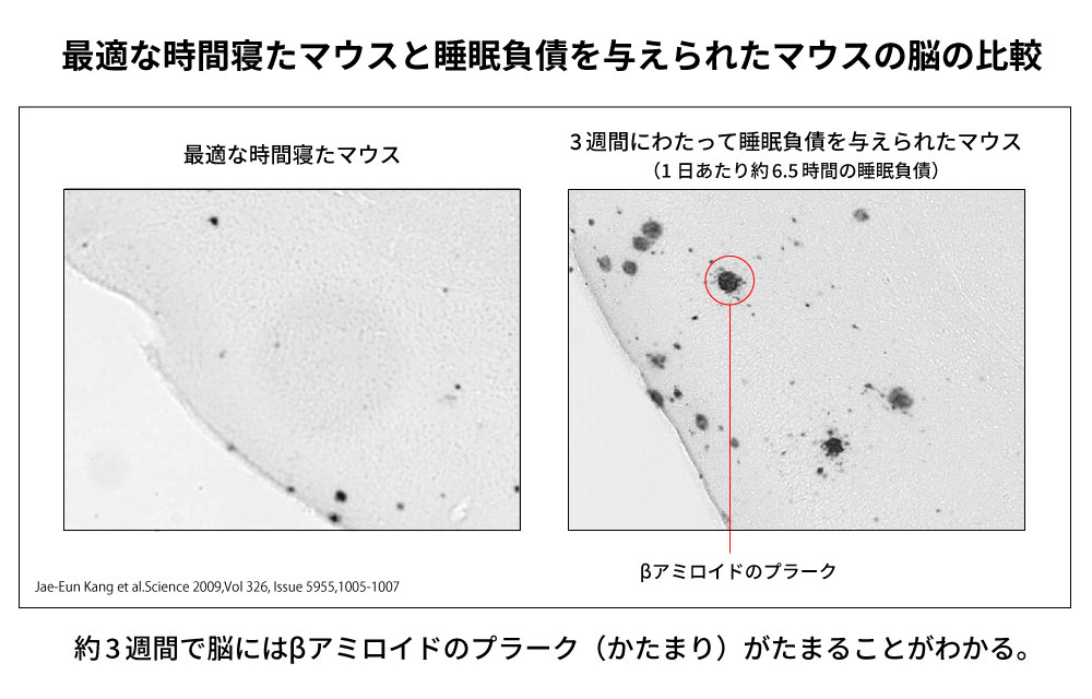 睡眠負債が蓄積すると、アルツハイマーの原因物質が脳内で増加